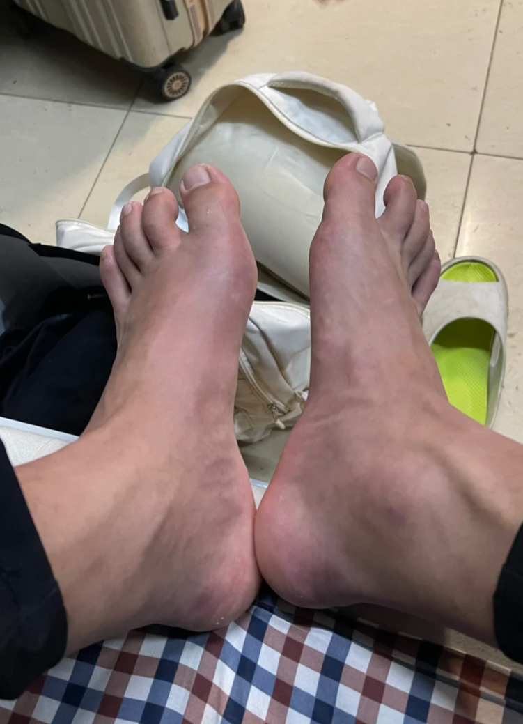 大拇脚指头疼,肿,一碰就疼