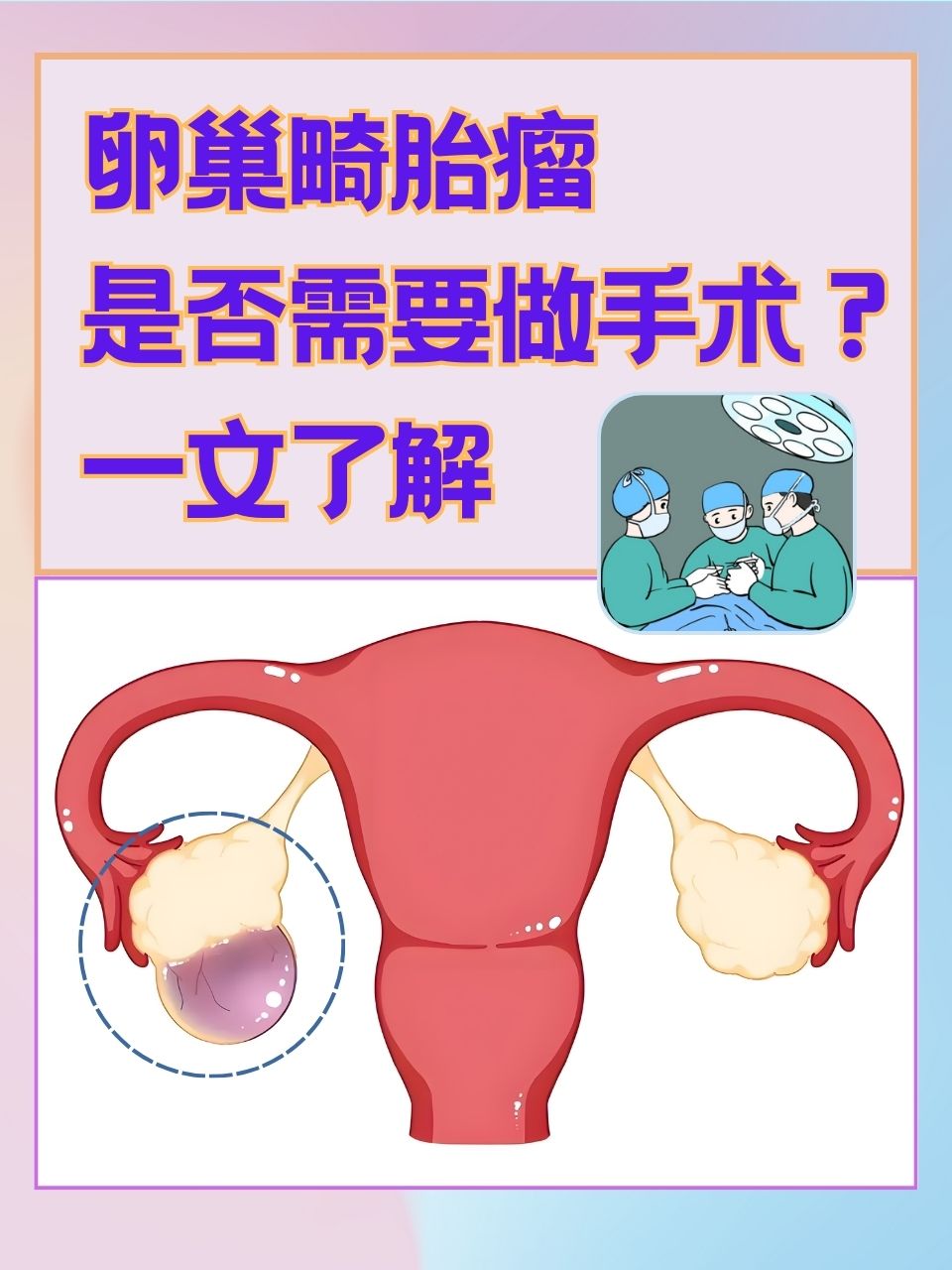 畸胎瘤是由什么原因引起的?