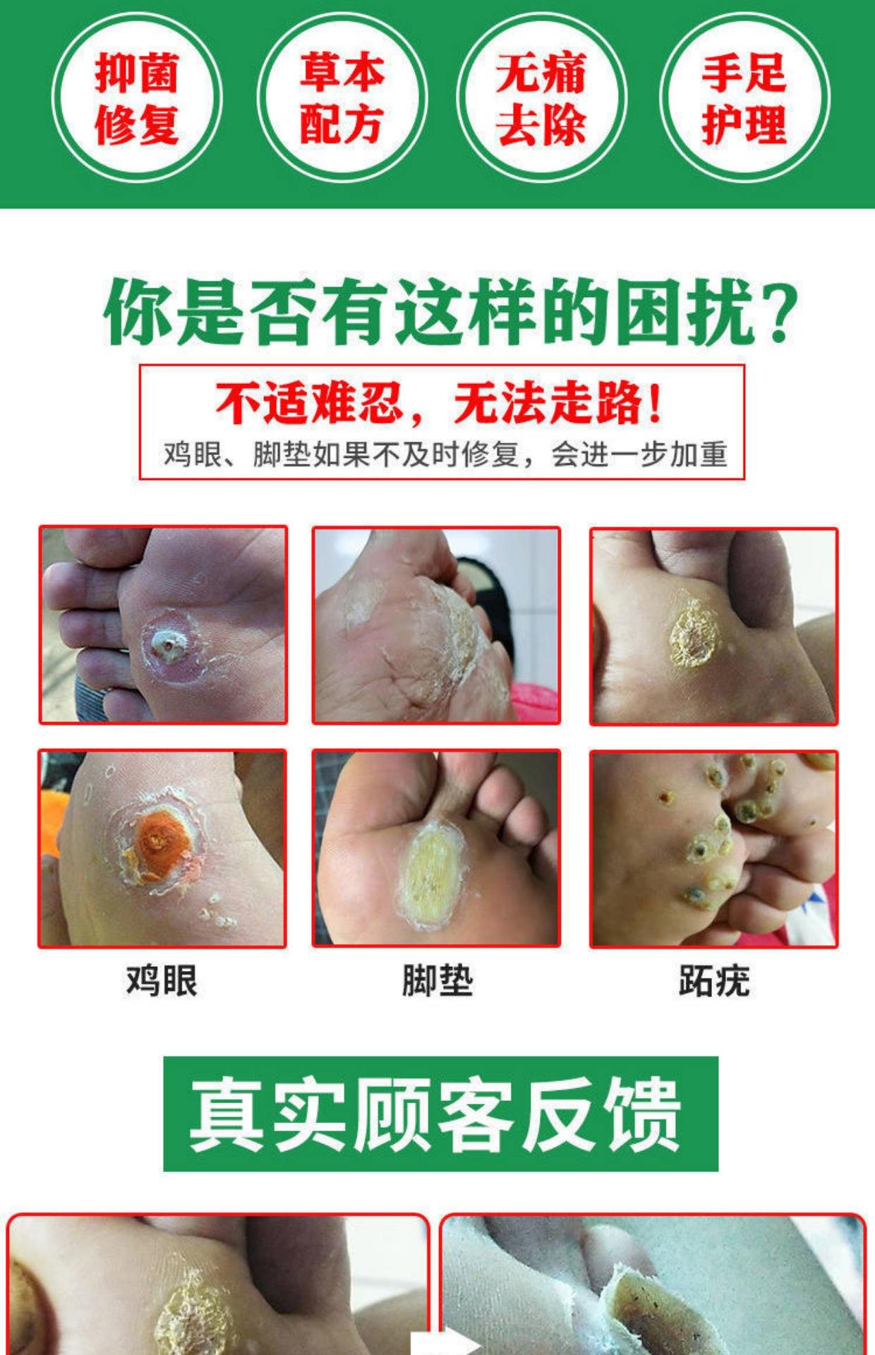 鸡眼一直用的鸡眼膏,昨天鸡眼膏用完了,用克鸡尤