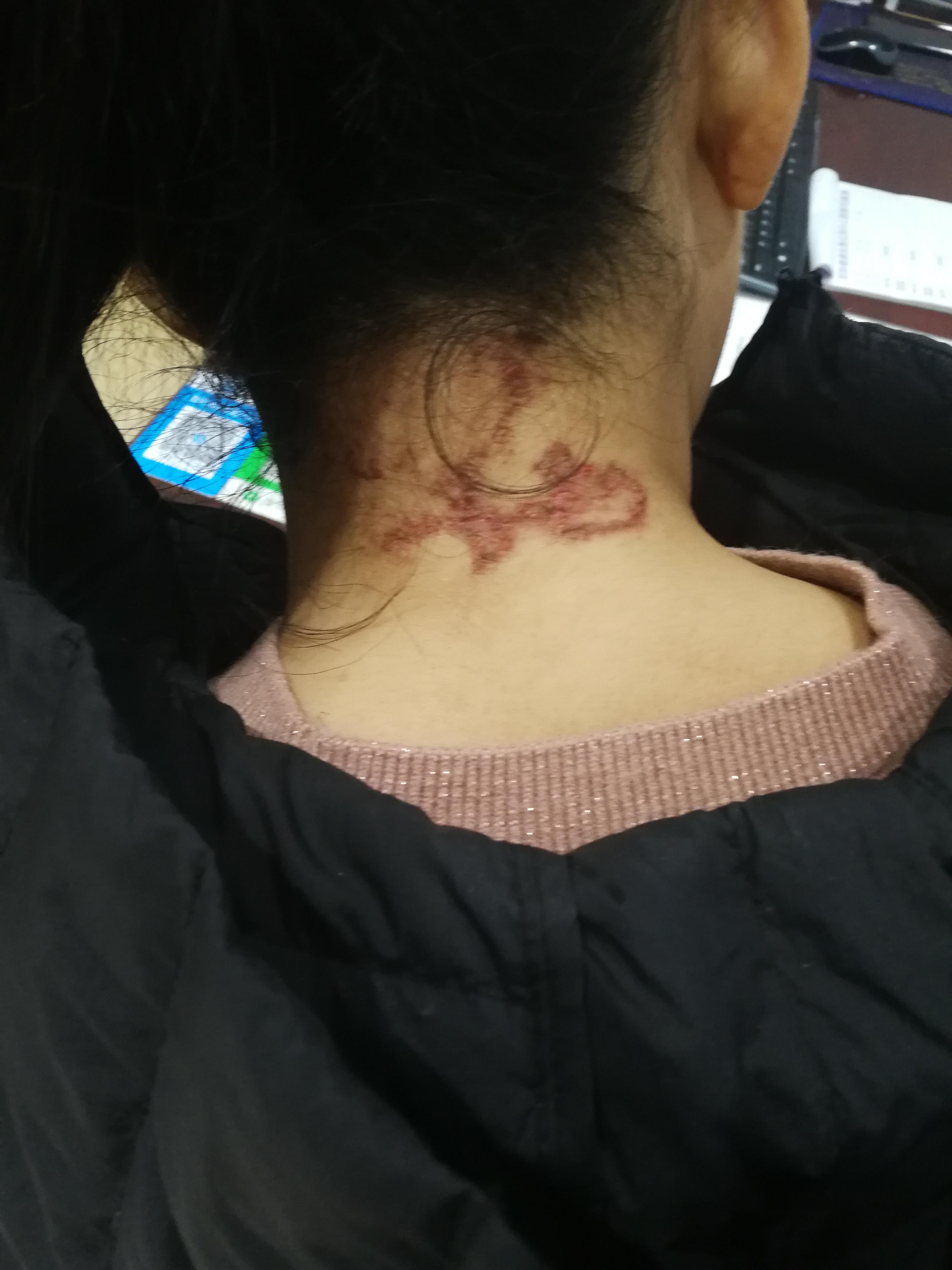 神经炎的症状有哪些