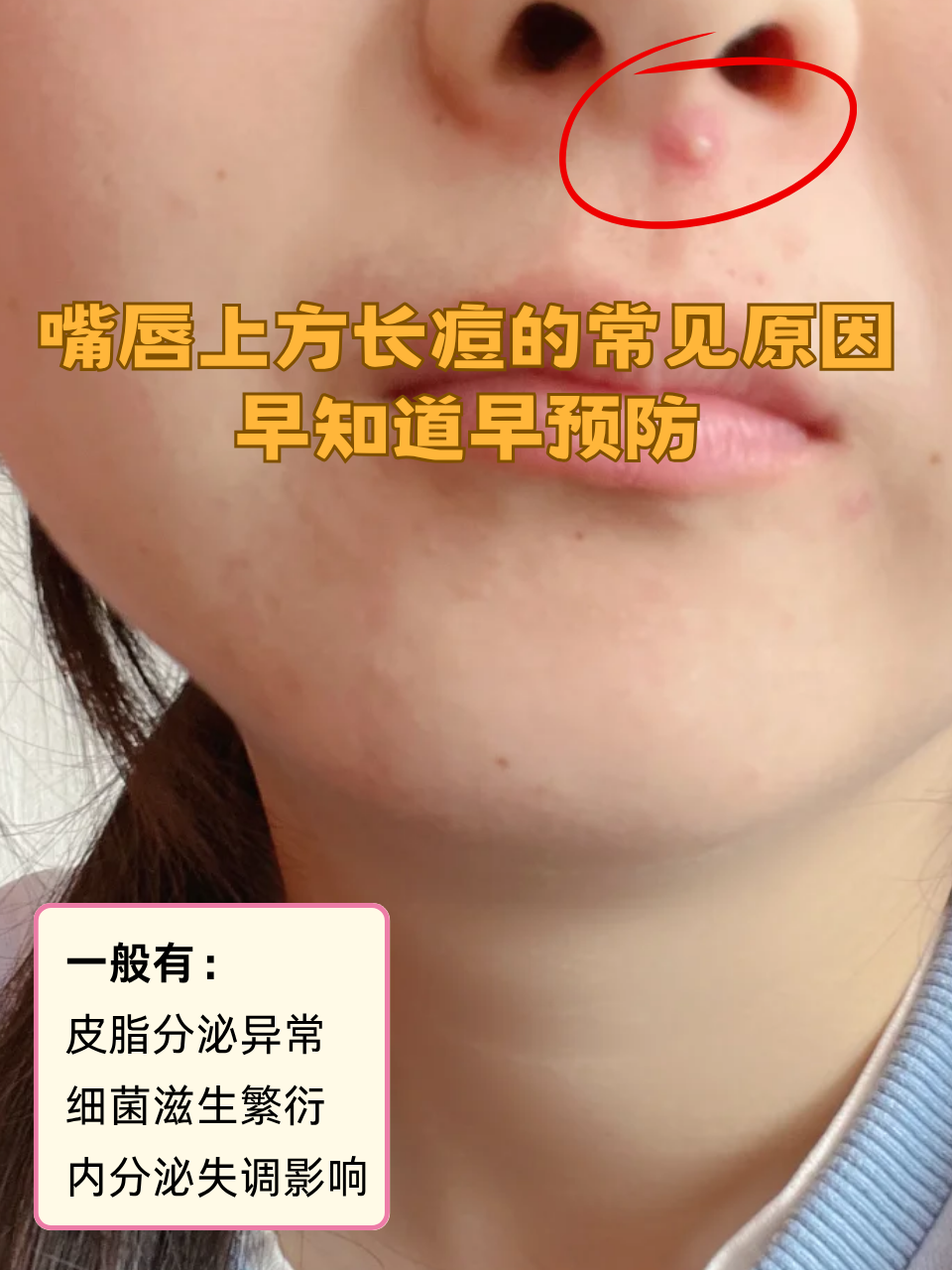 嘴唇上面长痘怎么回事