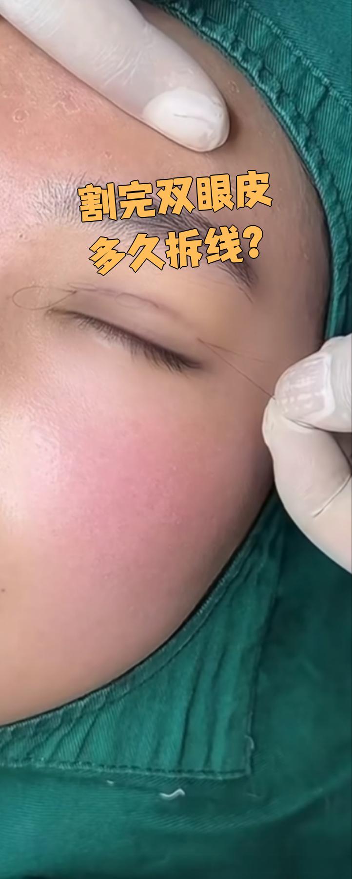 手术几天可以拆线