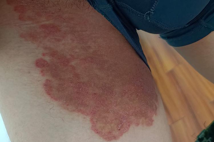 男性股癣,如何治疗好