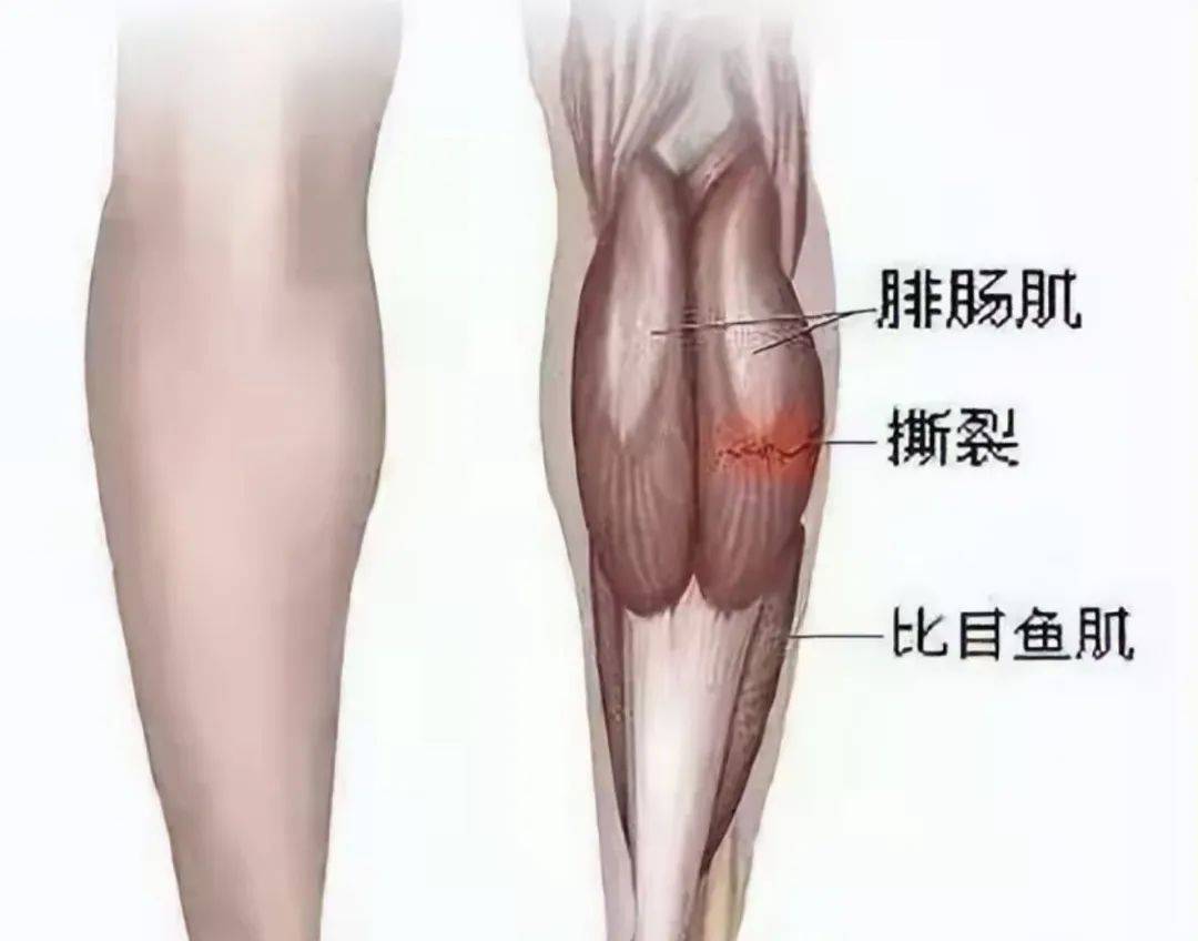 肌肉拉伤多久能恢复
