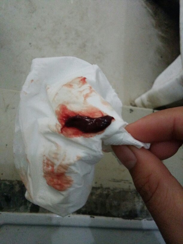 月经量大,有血块