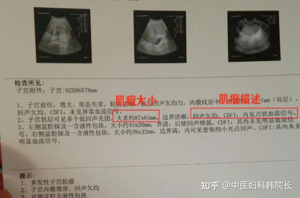 子宫壁低回声结节是什么意思