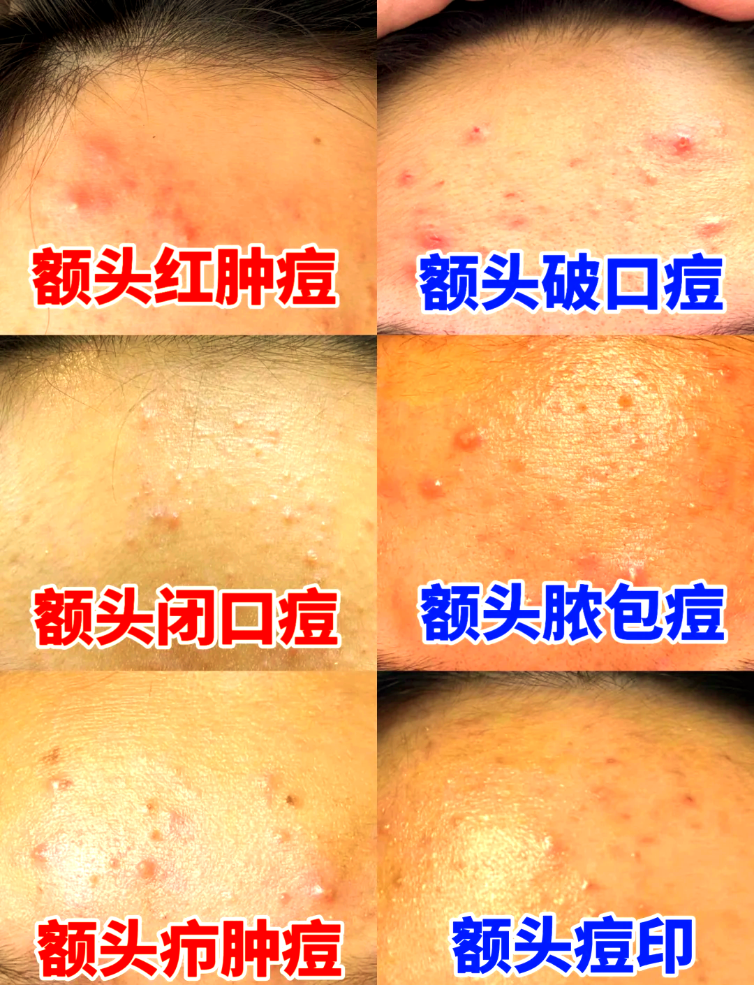 眉心长痘痘是怎么回事