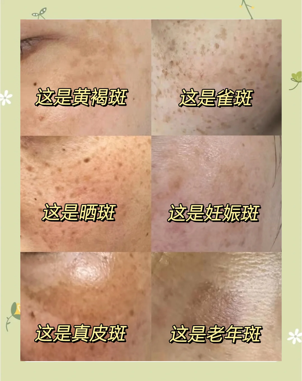 脸上长斑的原因