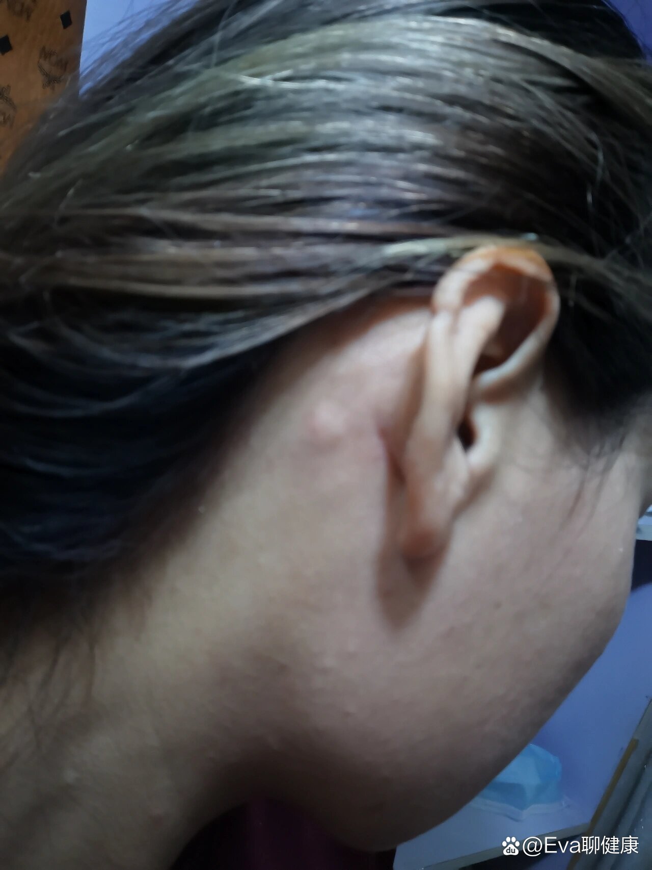 耳朵后面有个包很硬不痛不痒