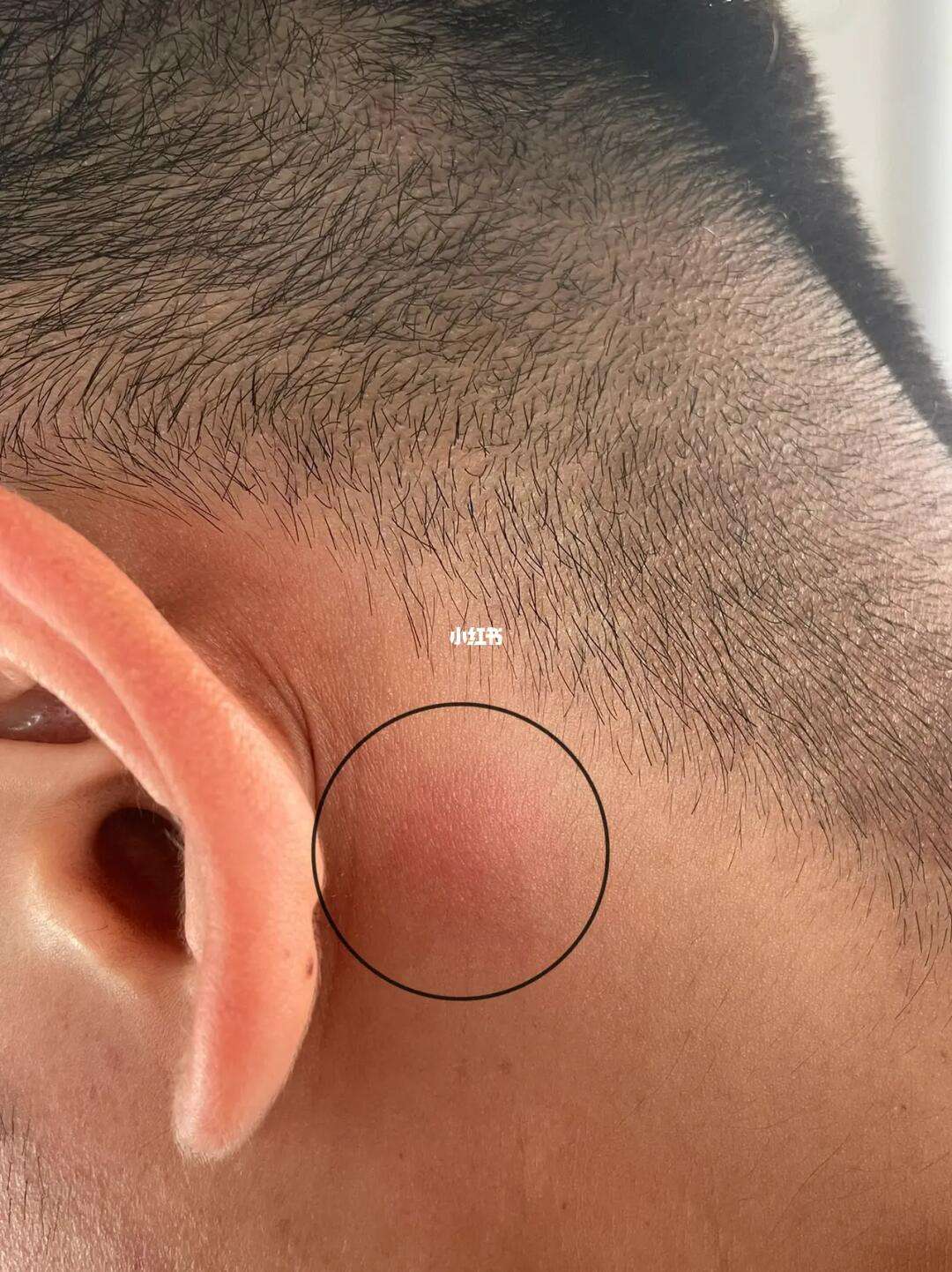 耳朵后面有个包很硬不痛不痒