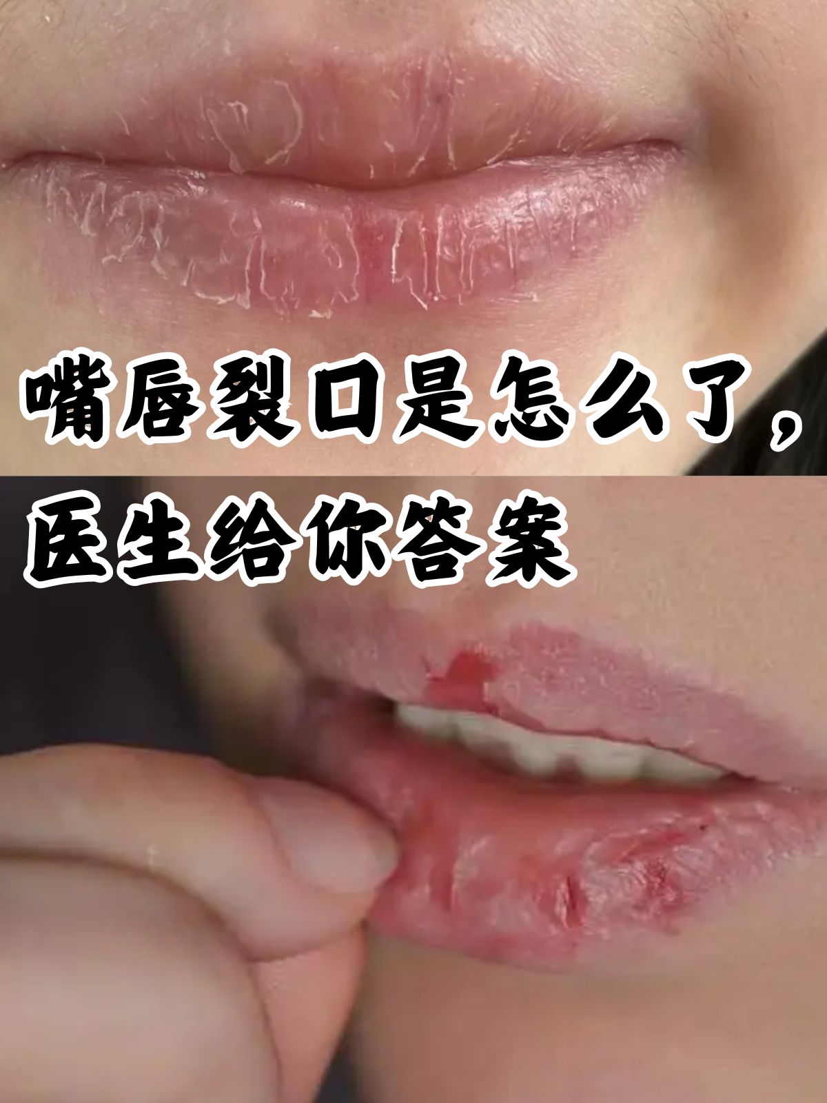 怎样快速补救嘴唇干裂