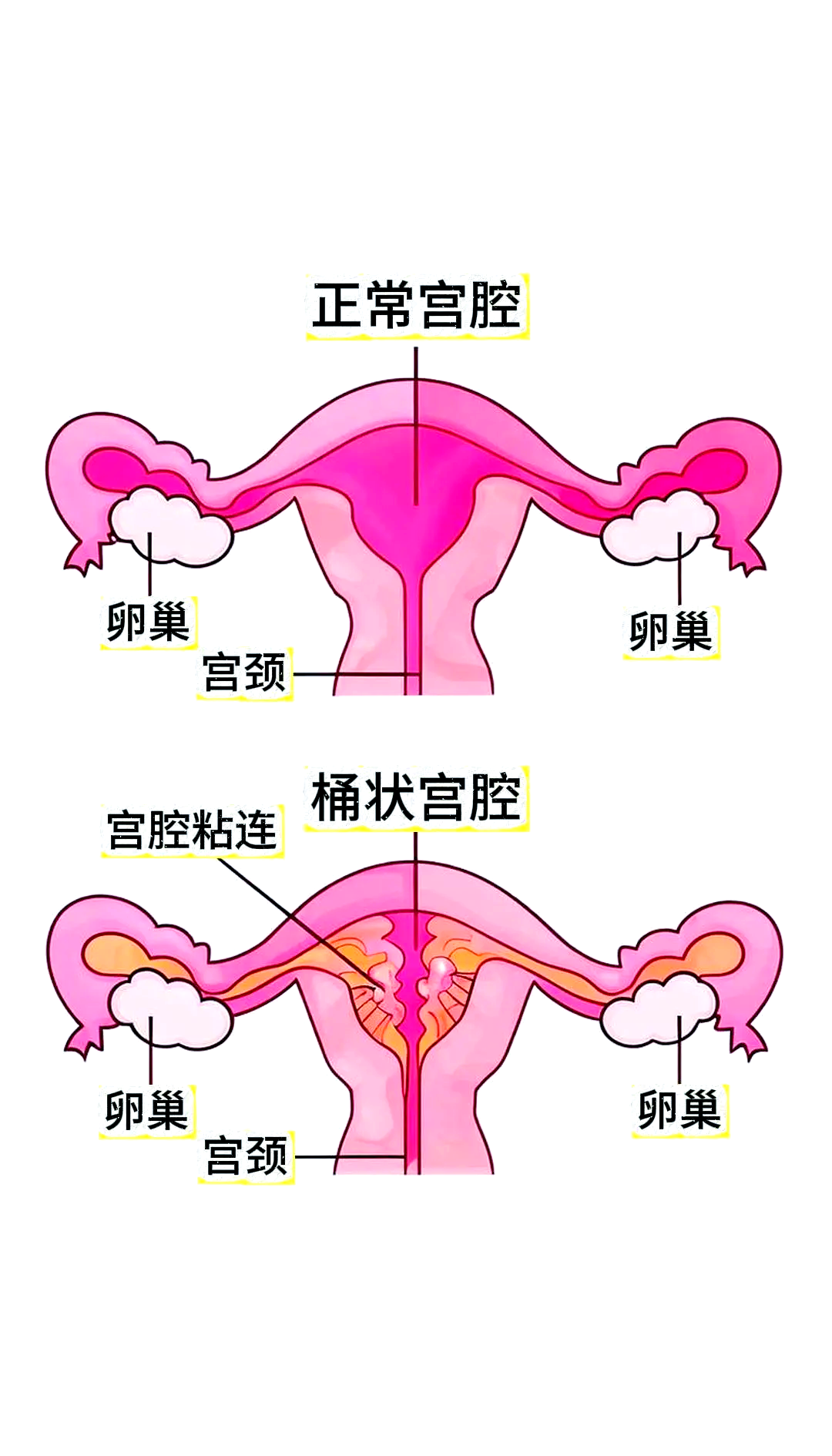 子宫粘连的症状都有哪些
