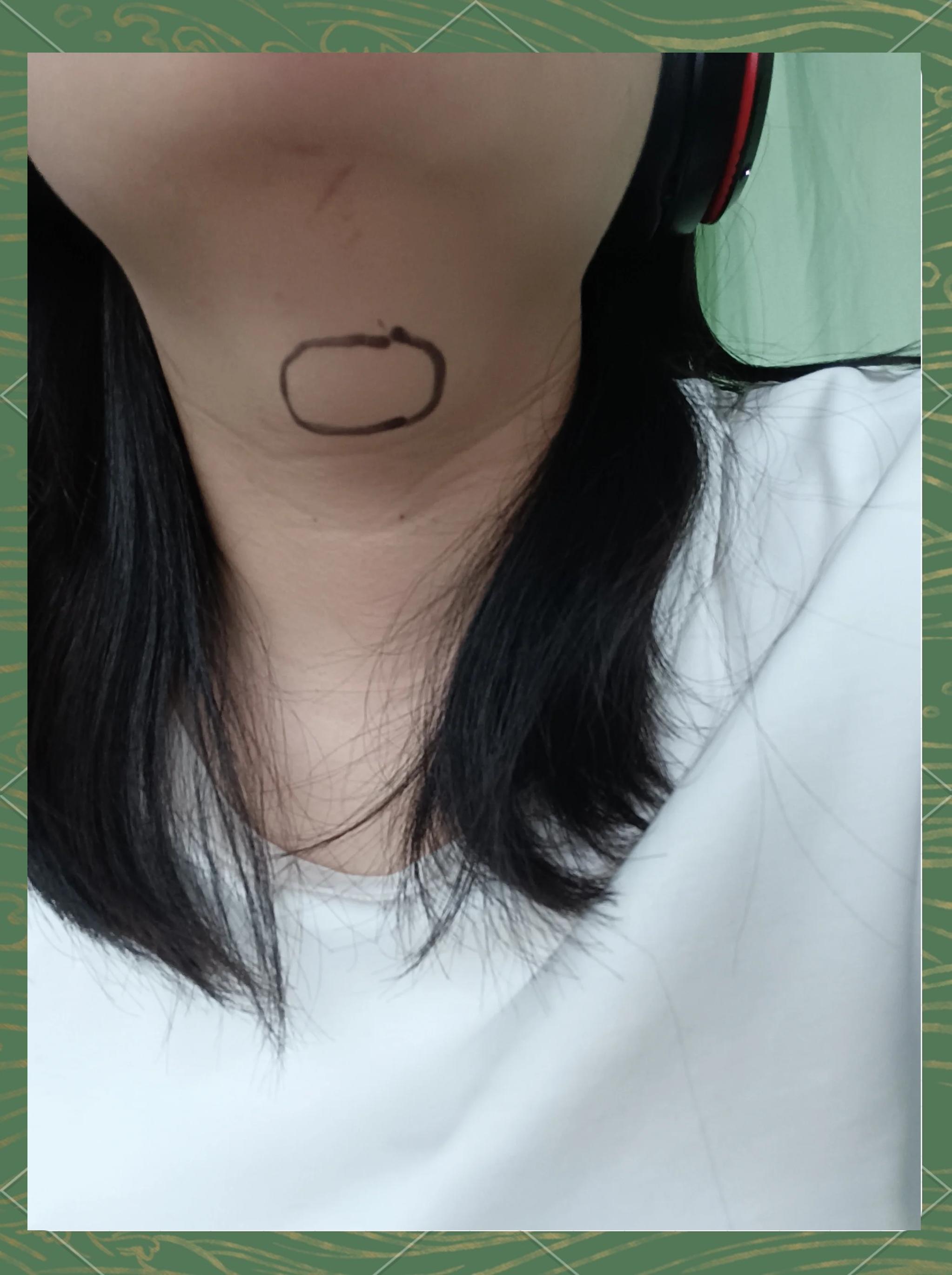 甲状腺滤泡囊肿???