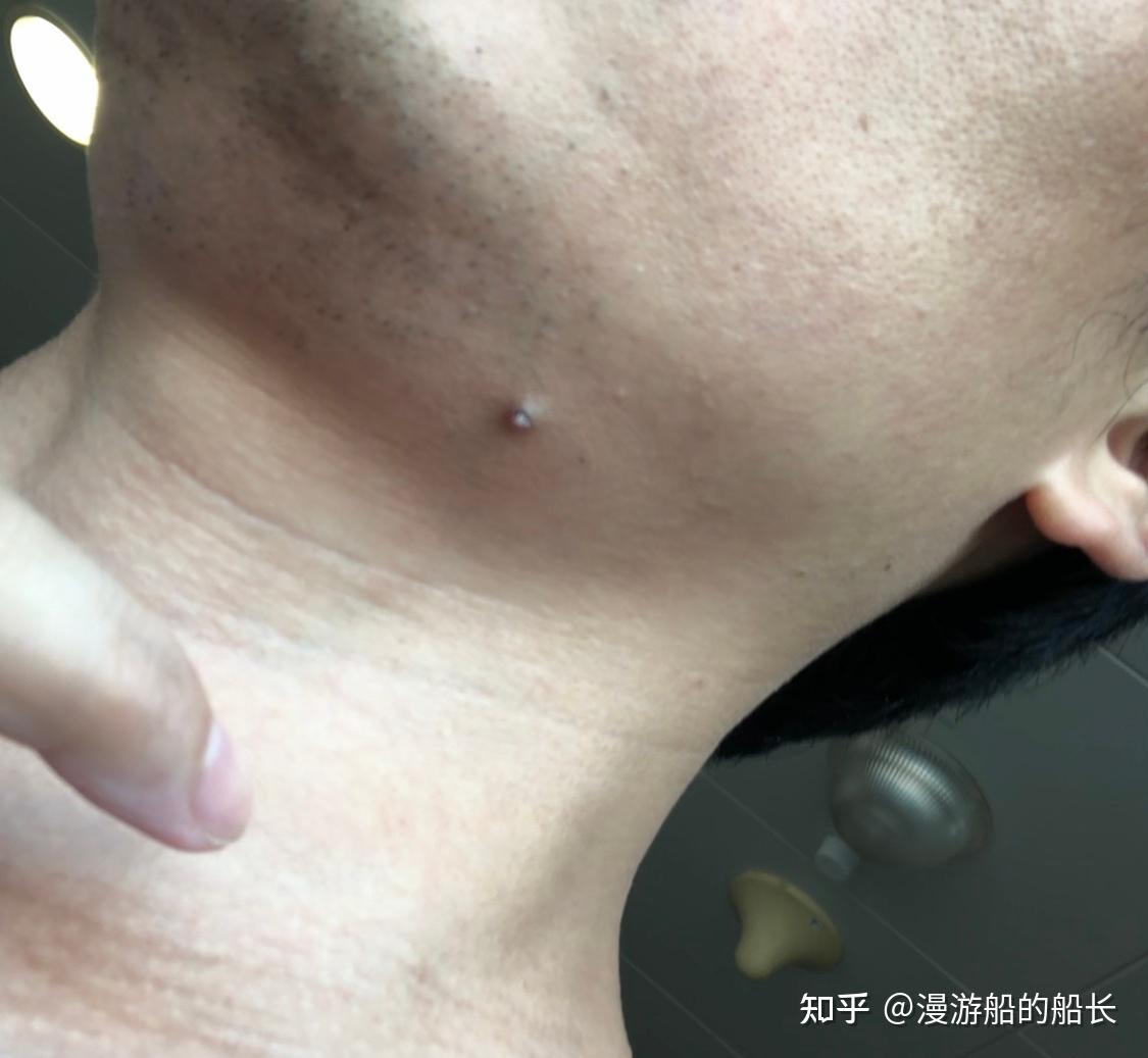 甲状腺滤泡囊肿???