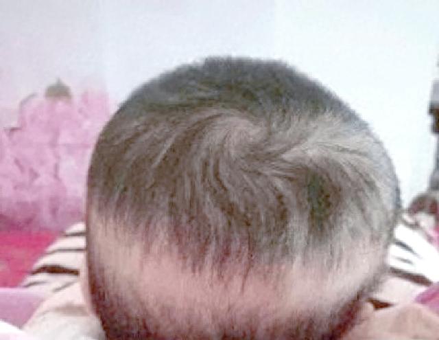 婴儿枕秃是什么原因引起的