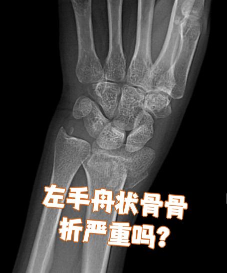 什么是腕舟状骨骨折