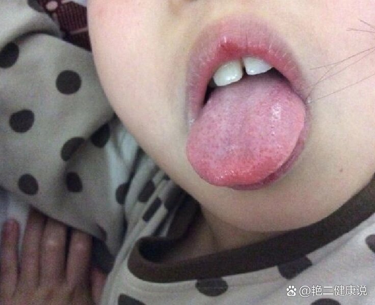 宝宝舌苔发白,是怎么回事?