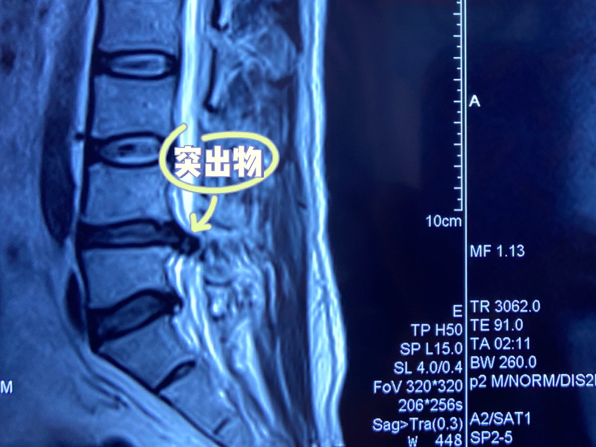 请问椎间盘变性是什么意思