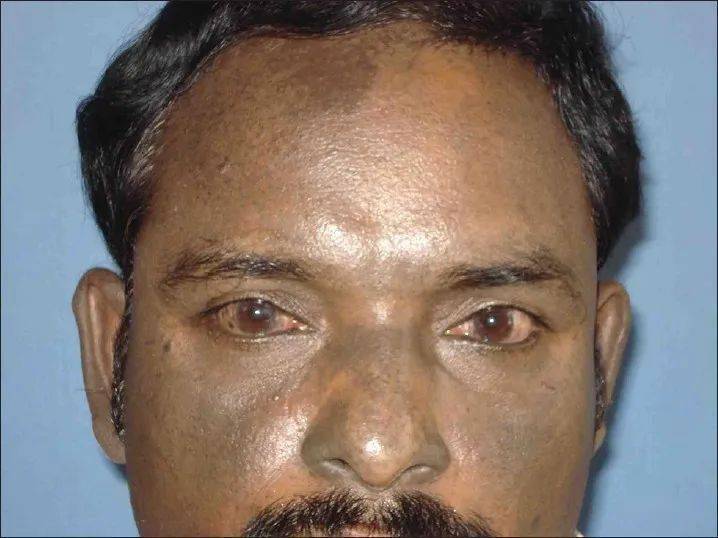 皮肤蓝斑是什么？原因和治疗靠谱吗？