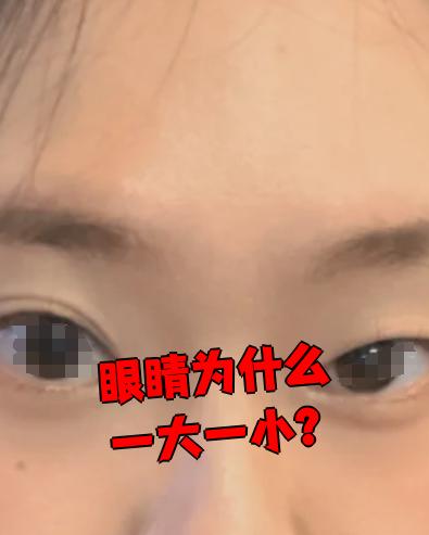 眼睛一大一小怎么治疗