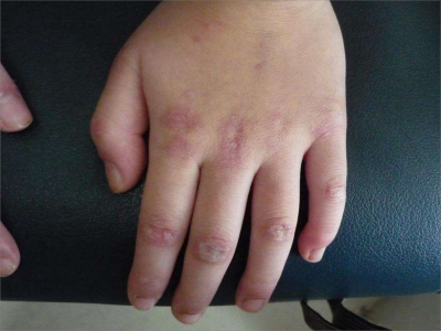 结缔组织病是什么意思?