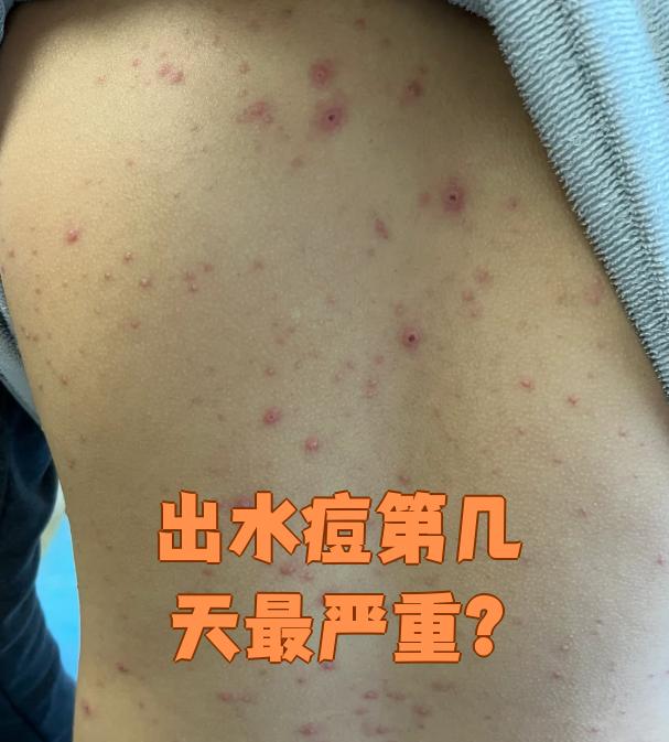 得了水痘大概几天能好