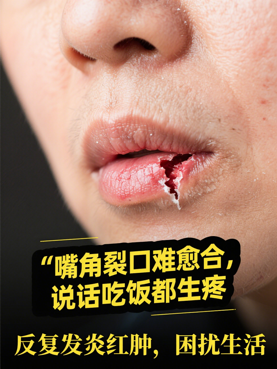 口角炎怎么治疗