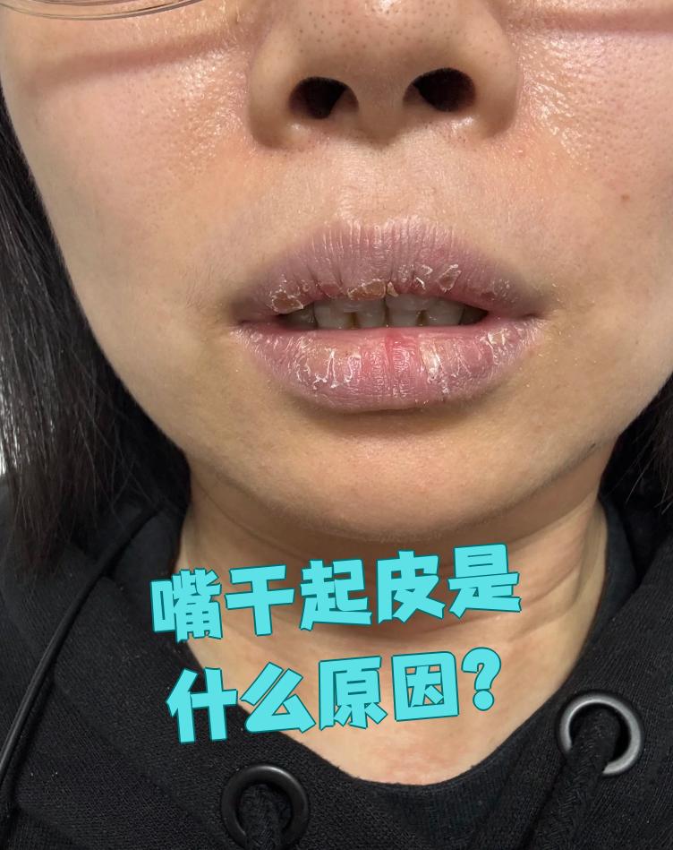 嘴皮干是怎么回事