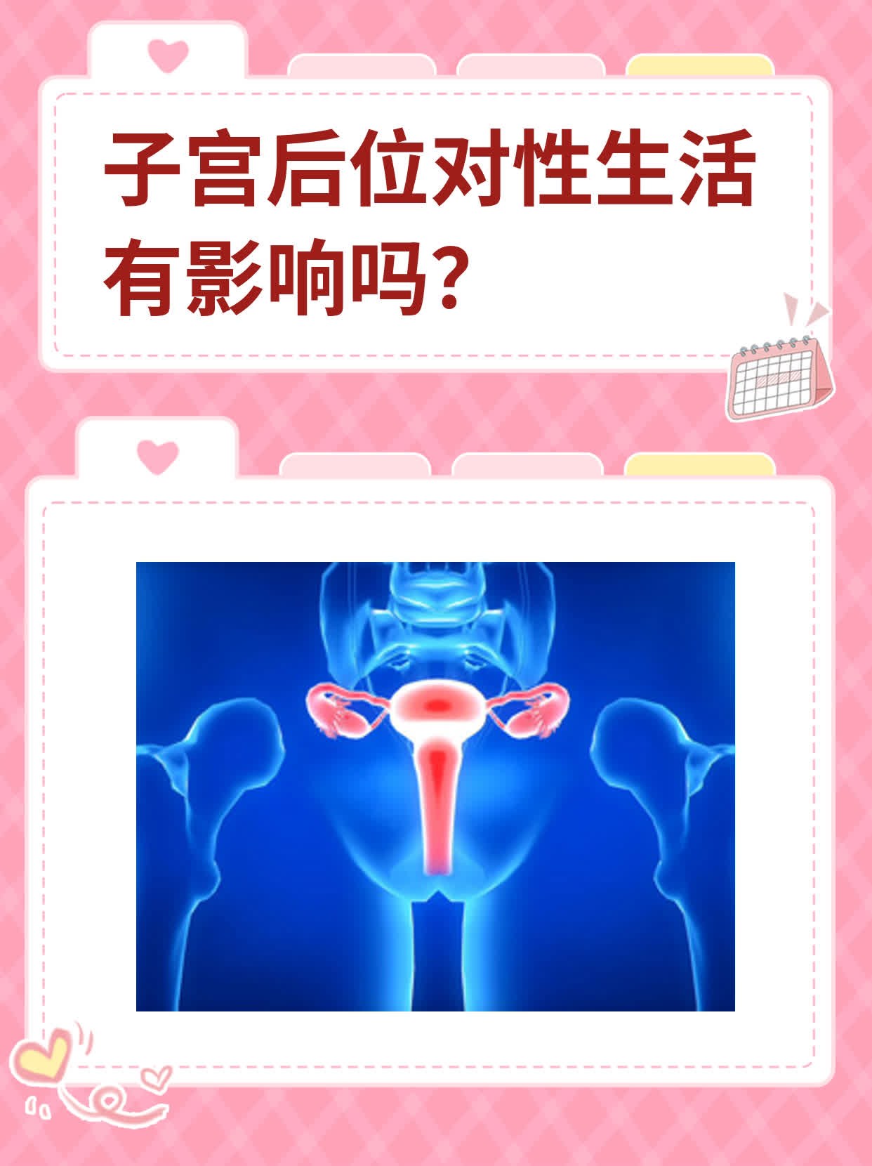 子宫憩室什么意思