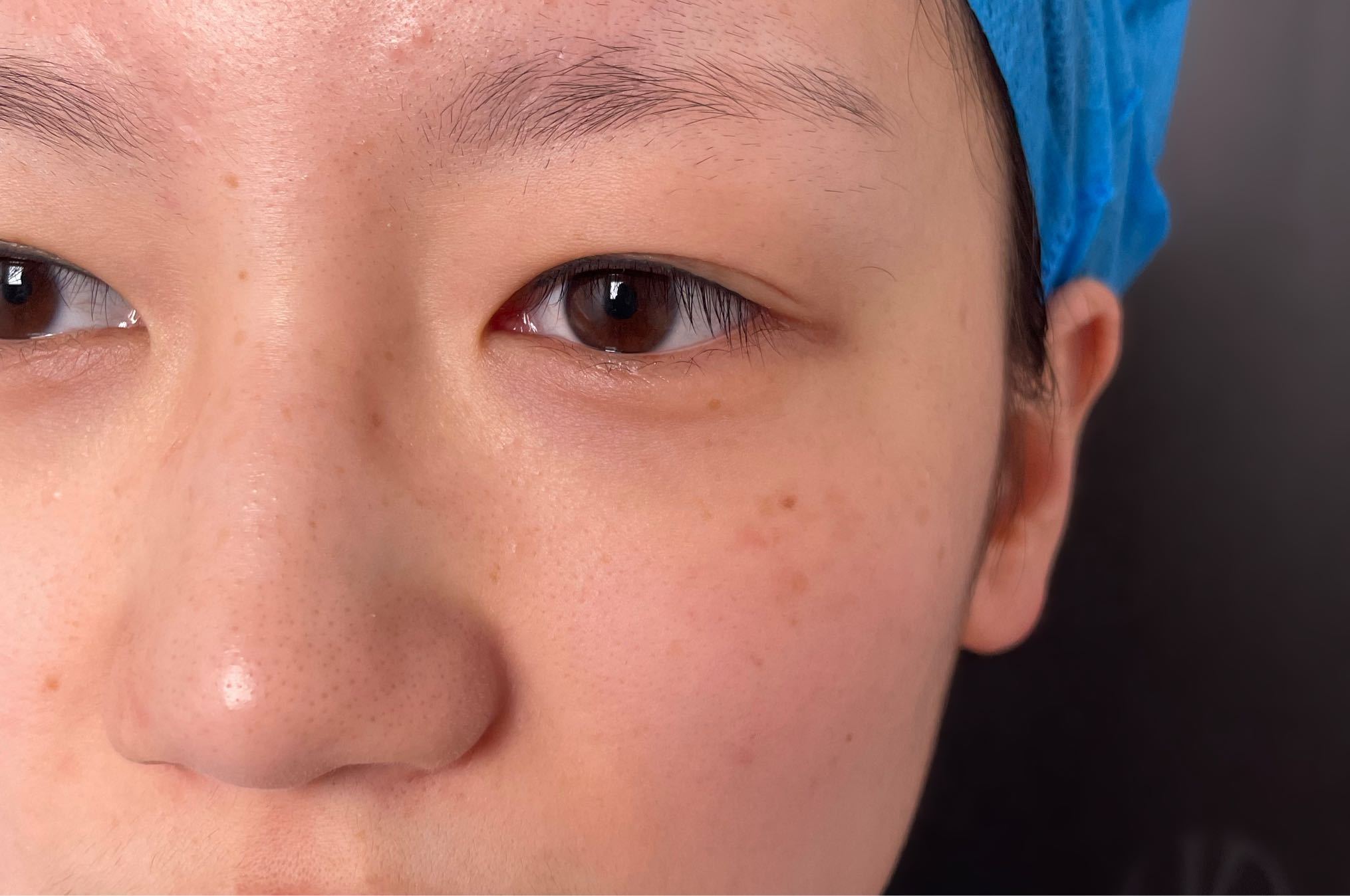 激光祛斑后多久能恢复