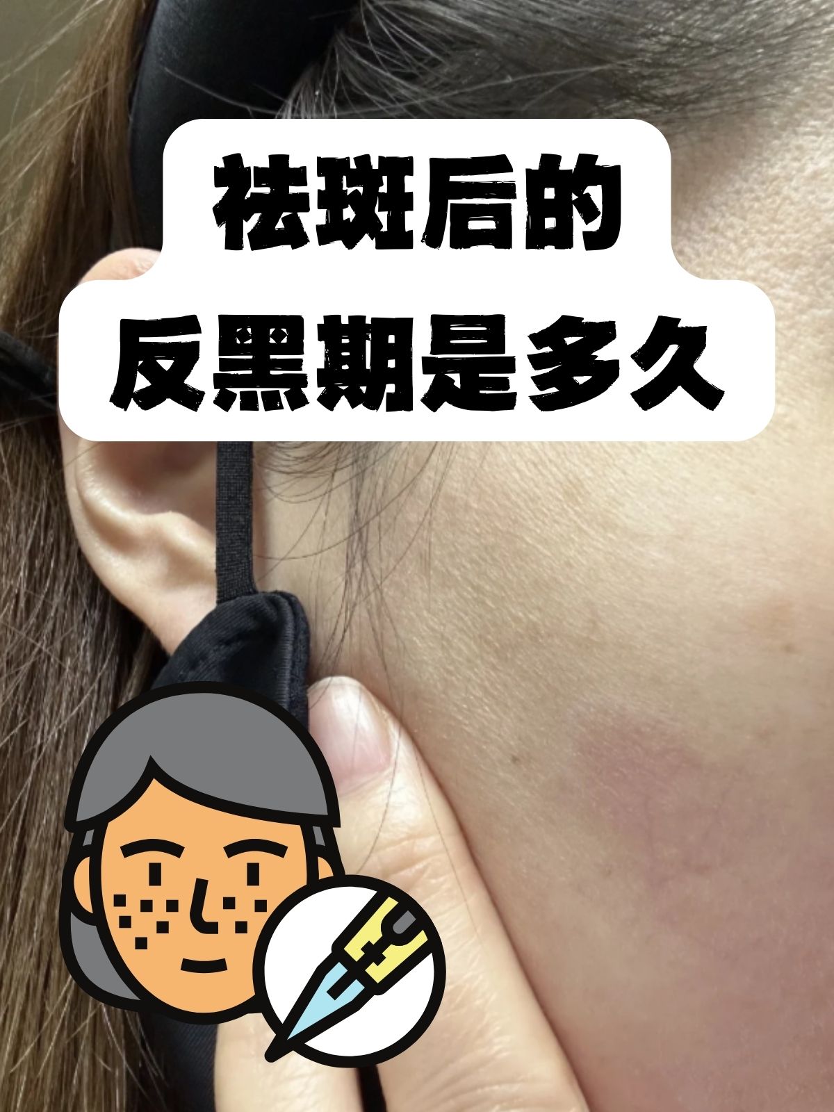 激光祛斑后多久能恢复