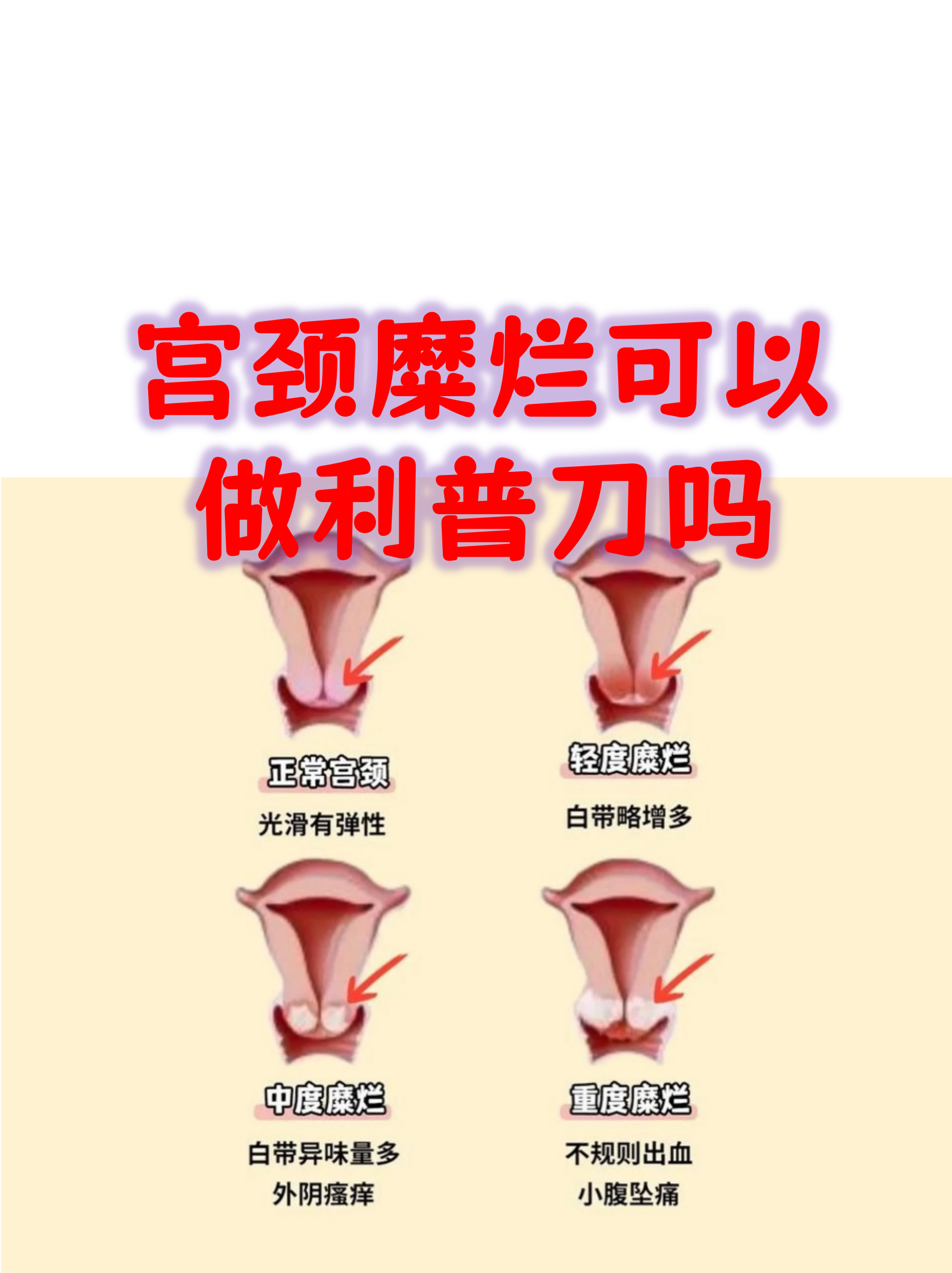 宫颈糜烂该如何治疗?