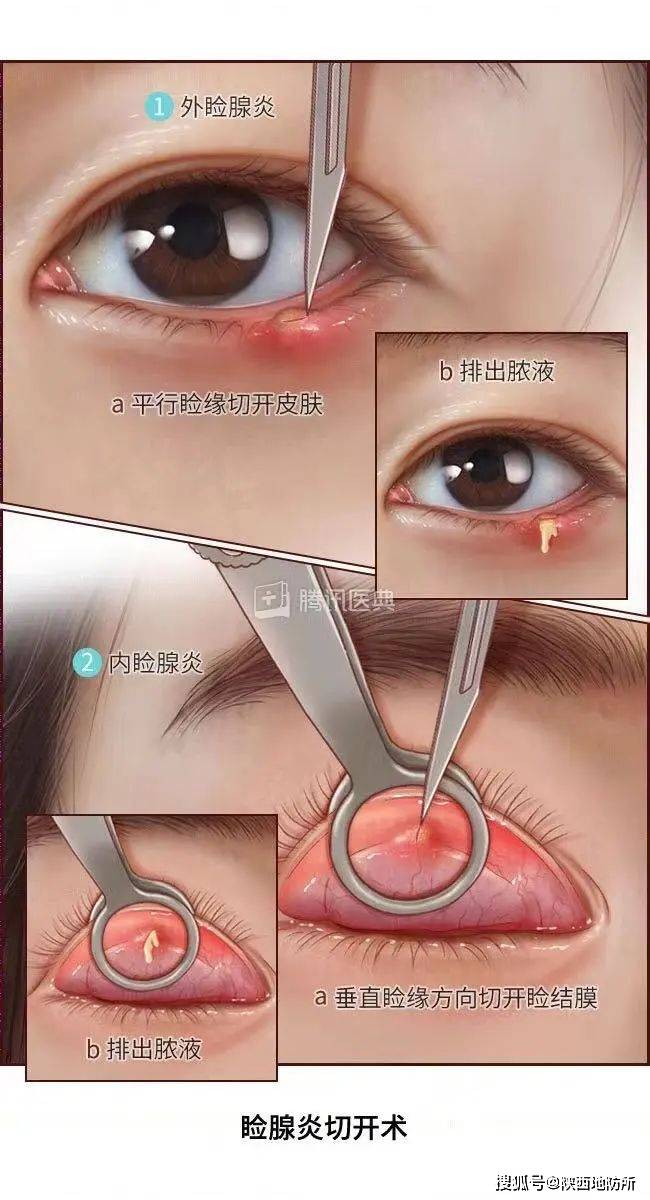 眼下睑穹窿部在什么位置