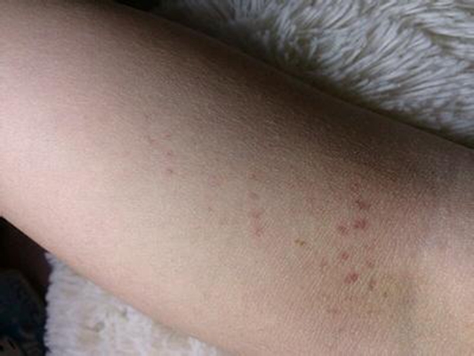 皮下出血点怎么回事?