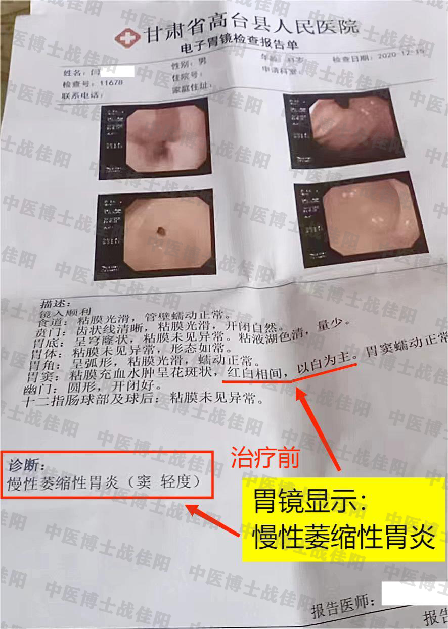 2010年左右我查出有萎缩性胃性轻度肠化