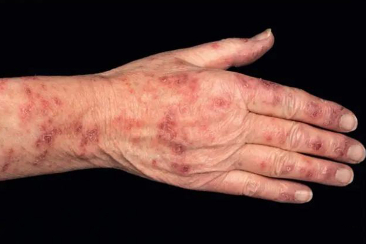 红斑狼疮早期症状