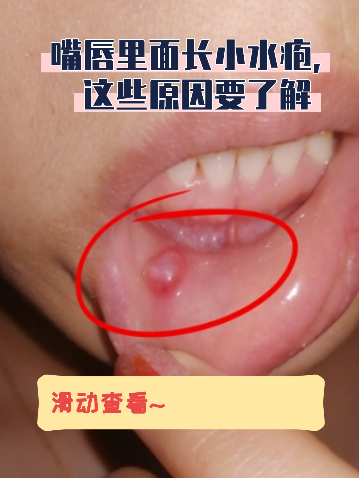 嘴唇上长泡泡怎么办!怎么解决