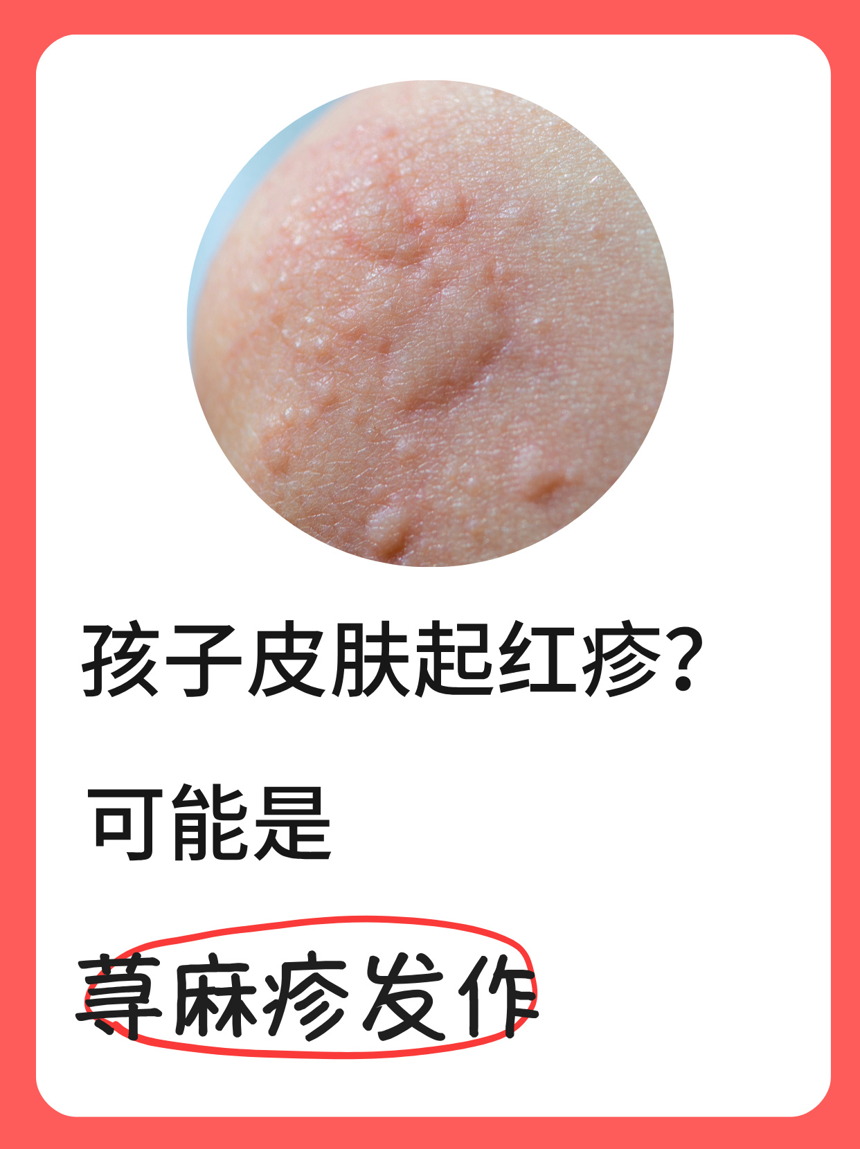 荨麻疹是过敏吗?