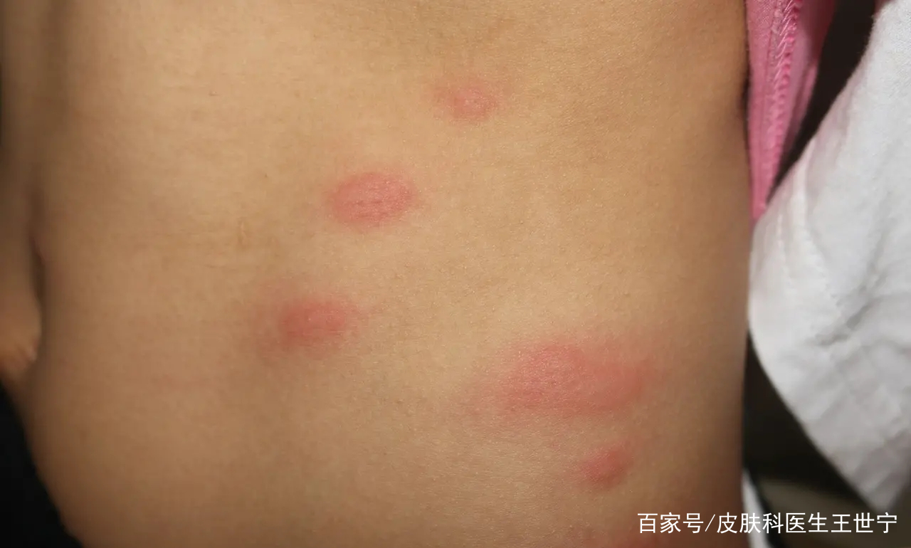 丘疹性荨麻疹症状有哪些