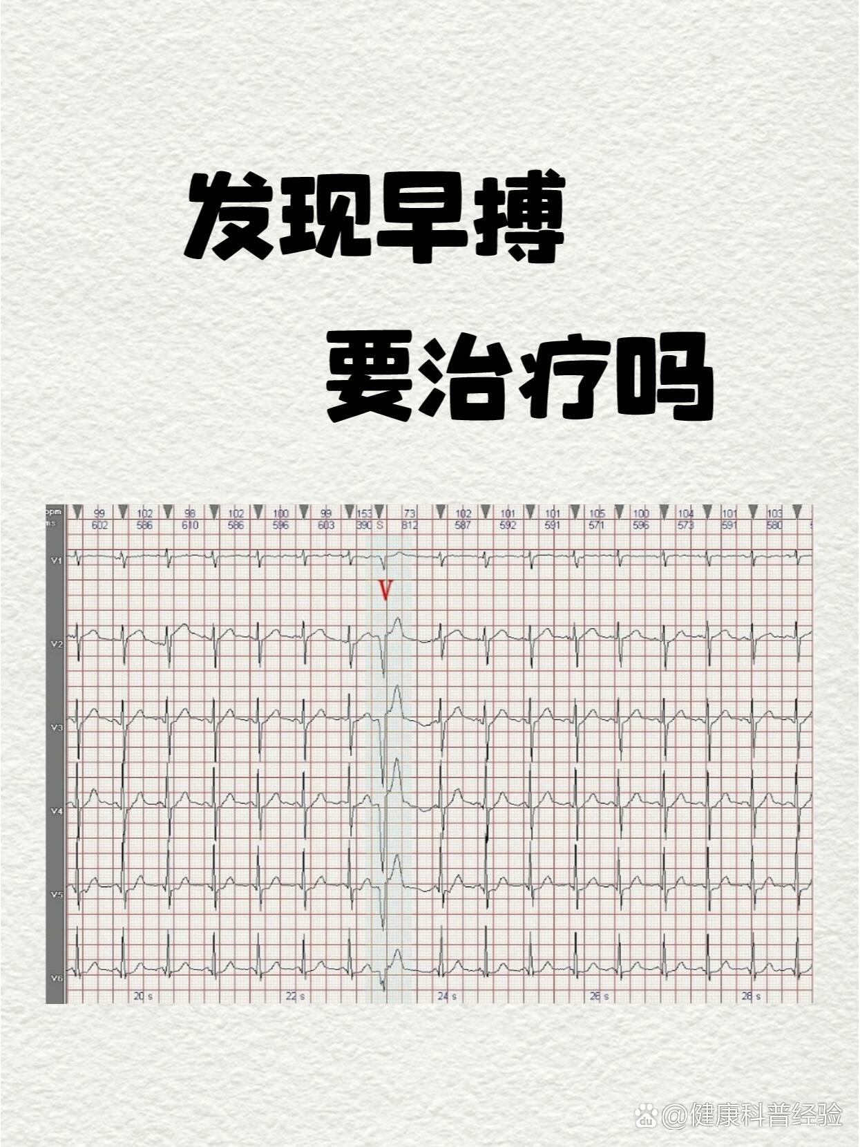 心律早搏是什么意思