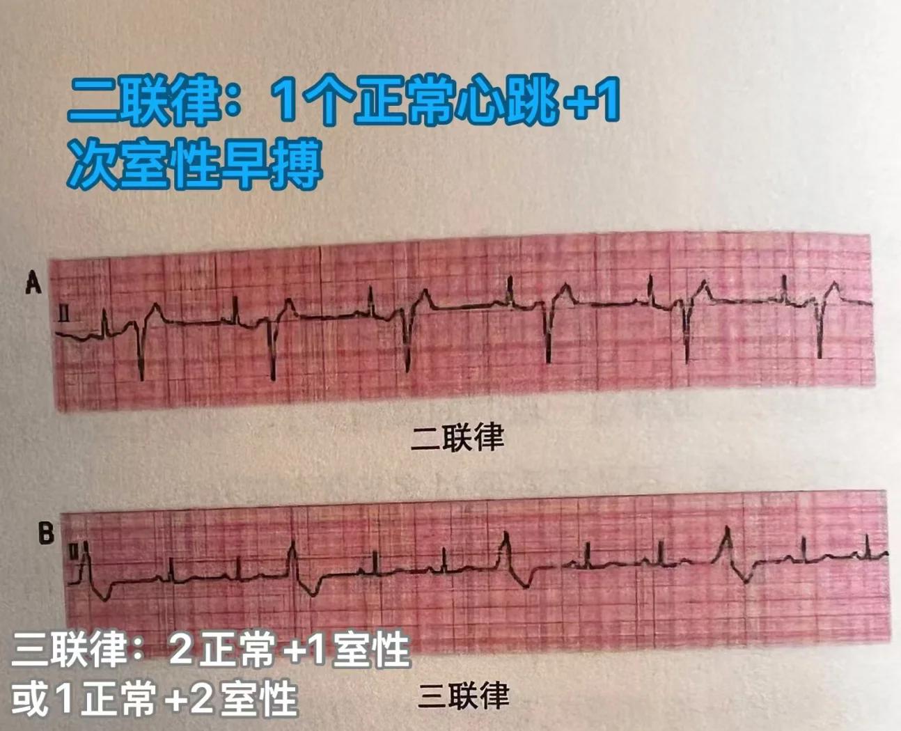 心律早搏是什么意思