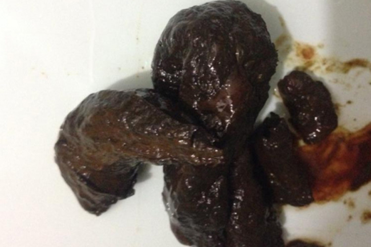 上消化道出血粪便颜色