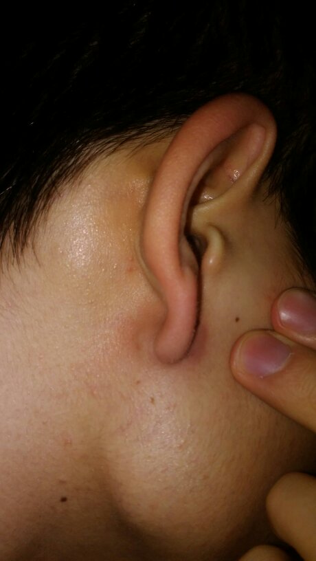 耳朵下面长了个硬包,不痛不痒