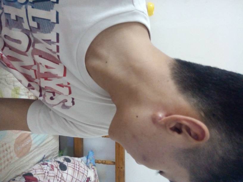 耳朵下面长了个硬包,不痛不痒