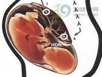 什么是新生儿溶血