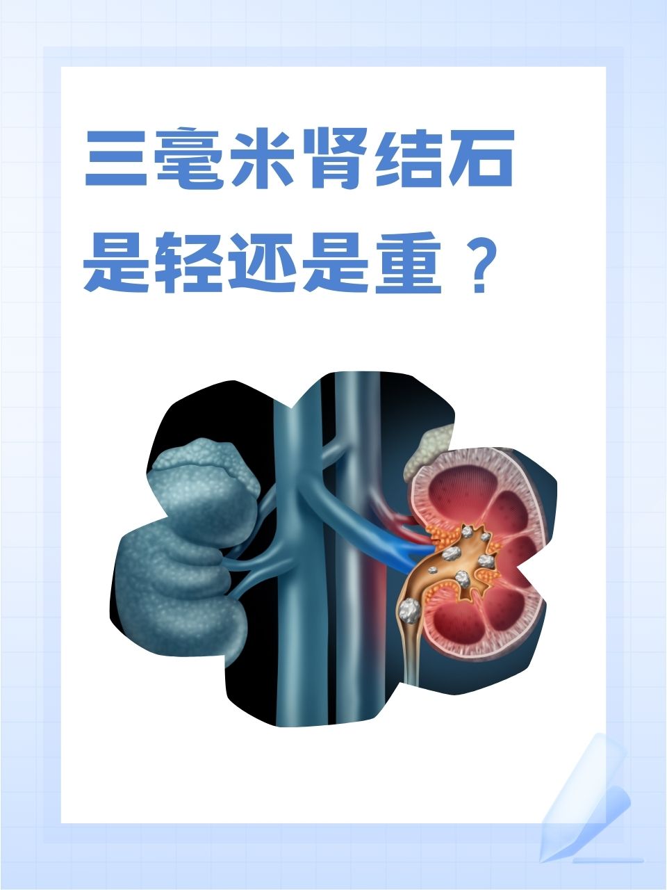 为什么会得肾结石呢?