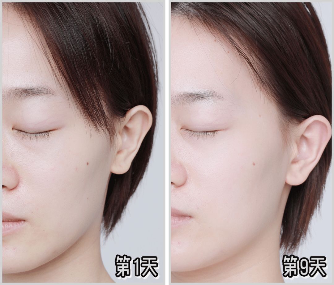 瘦腿针多少钱一支一般的价格在两千元左右