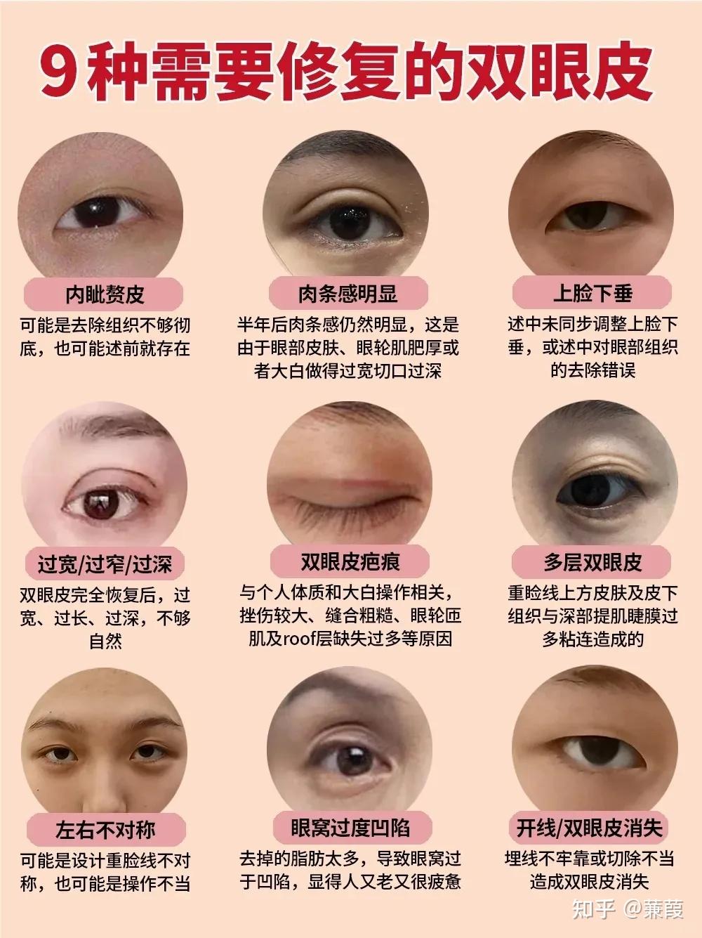 割双眼皮会痛吗