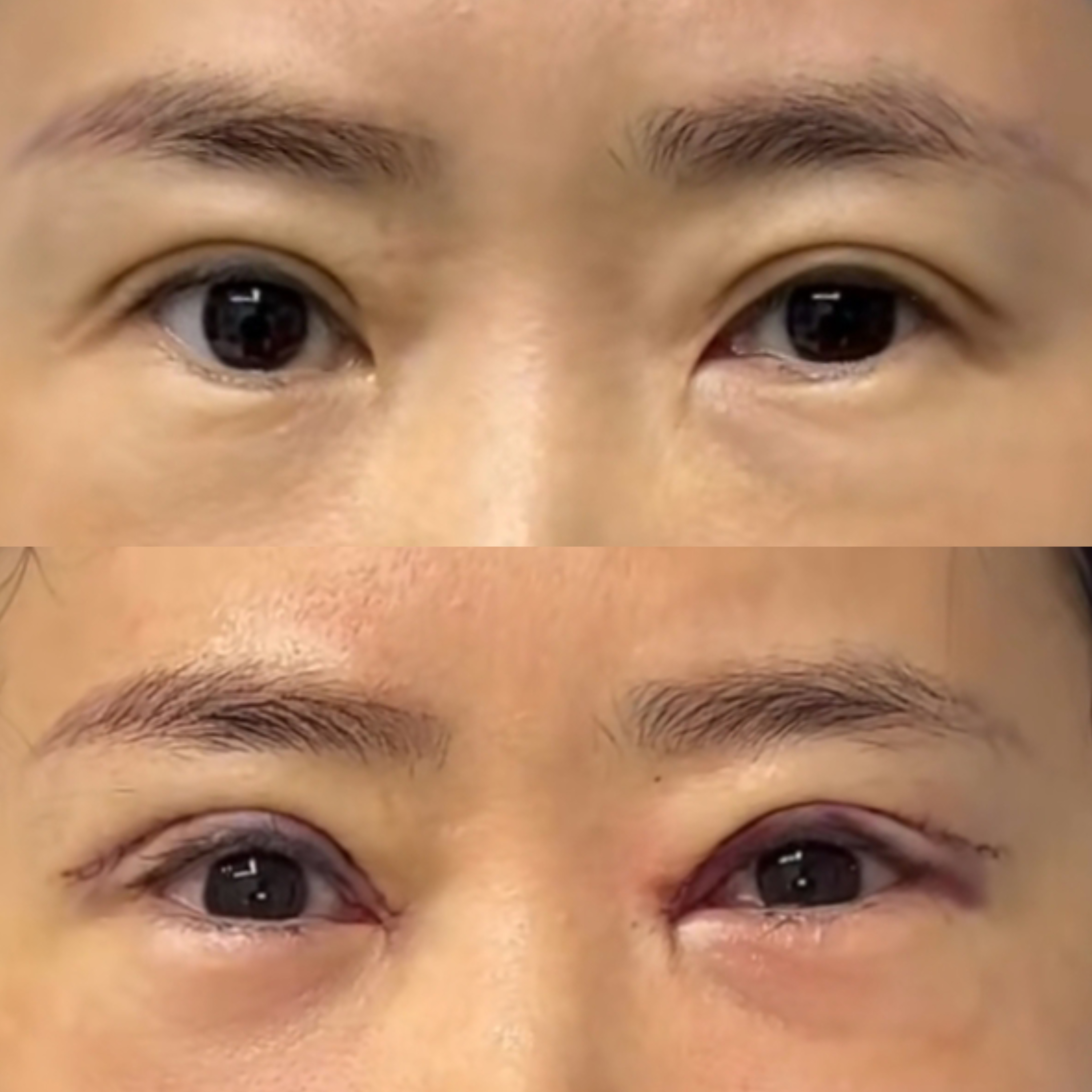 割双眼皮会痛吗