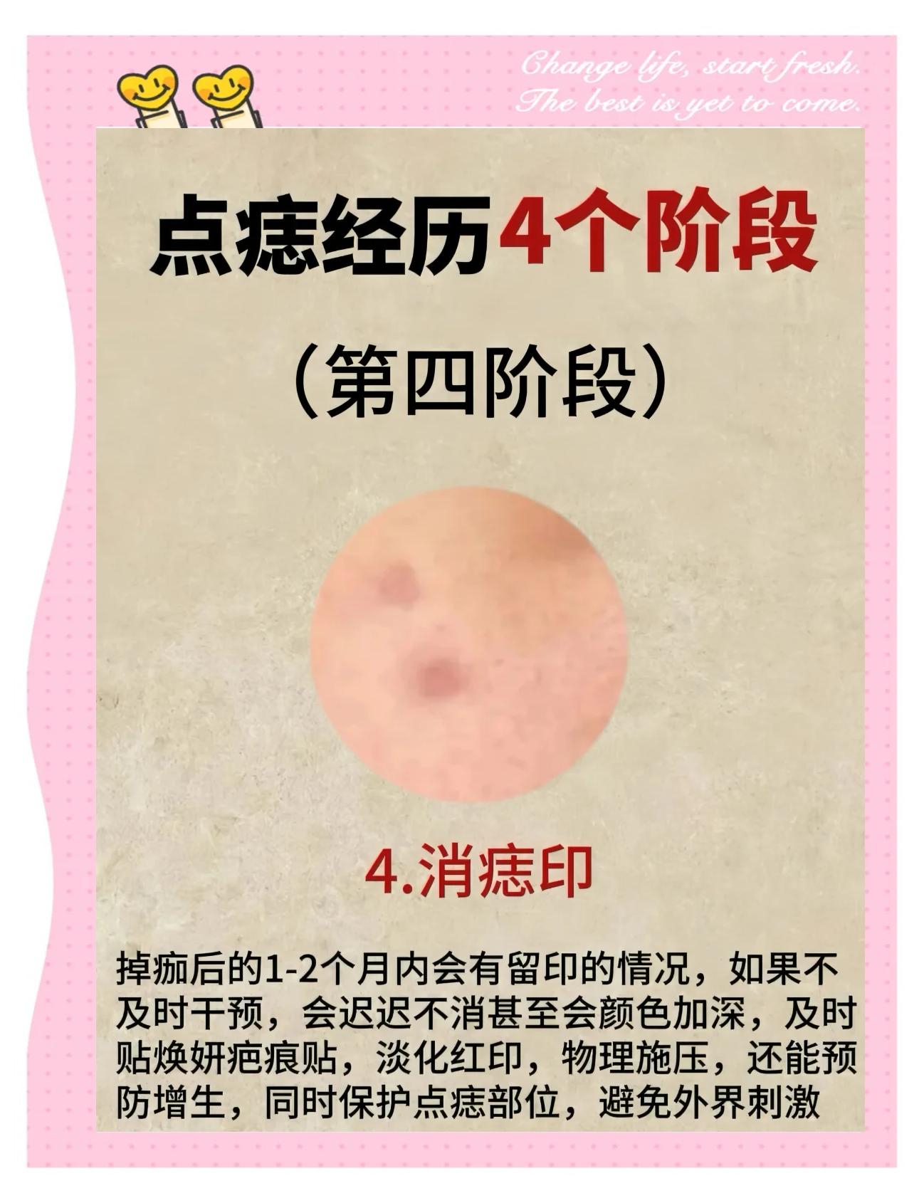 点完痣要注意什么,不能吃什么